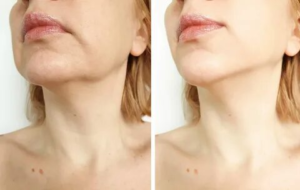 Renuvion Treatment: Non-Surgical Skin Tightening