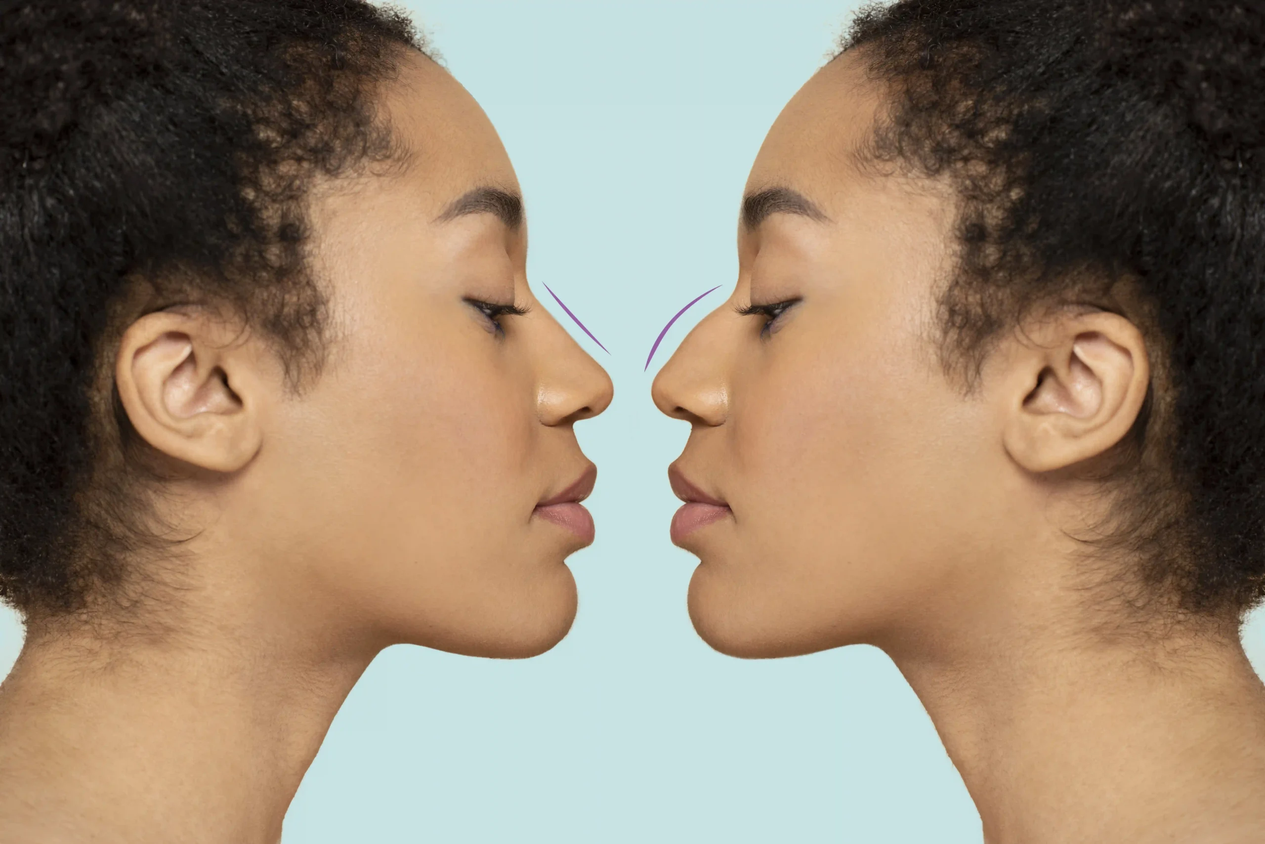 ethnic rhinoplasty nyc